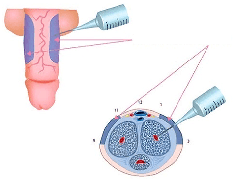 suntikan untuk menebalkan penis
